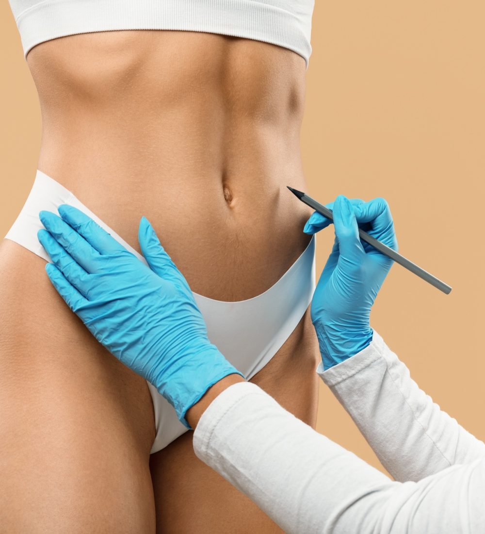 Doctor drawing marks on female stomach, preparing for cosmetic surgery operation Doctor drawing marks on female stomach, preparing for cosmetic surgery operation